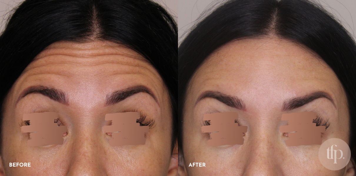 Anti Wrinkle Injections